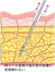KBシース使用例 KBシース使用で吸引管が皮膚に直接触れない