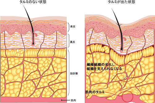 タルミのない状態 タルミの出た状態