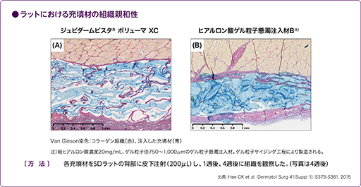 ジュビダームビスタ®ボリューマXC