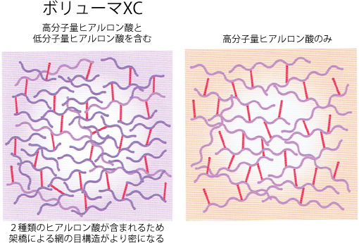 ジュビダームビスタ®ボリューマXC