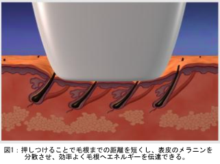 図１：押し付けることで毛根までの距離を短くし、表皮のメラニンを分散させ、効率よく毛根へエネルギーを伝達できる。