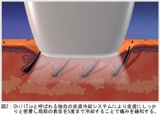 図２：ChillTipと呼ばれる独自の皮膚冷却システムにより皮膚にしっかりと密着し局部の表皮を5度まで冷却することで痛みを緩和する。