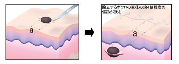 外科的治療例