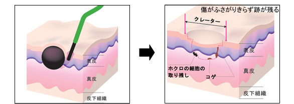 電気メス治療例