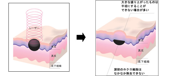 レーザー治療例